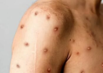 España es el país europeo con más incidencia de viruela del mono, con 8.104 casos desde 2022