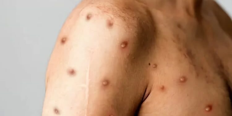 Spain is the European country with highest incidence of monkeypox: 8,104 cases since 2022